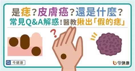 凸痣長毛|是痣？皮膚癌？還是什麼？常見Q&A解惑！醫教揪出「。